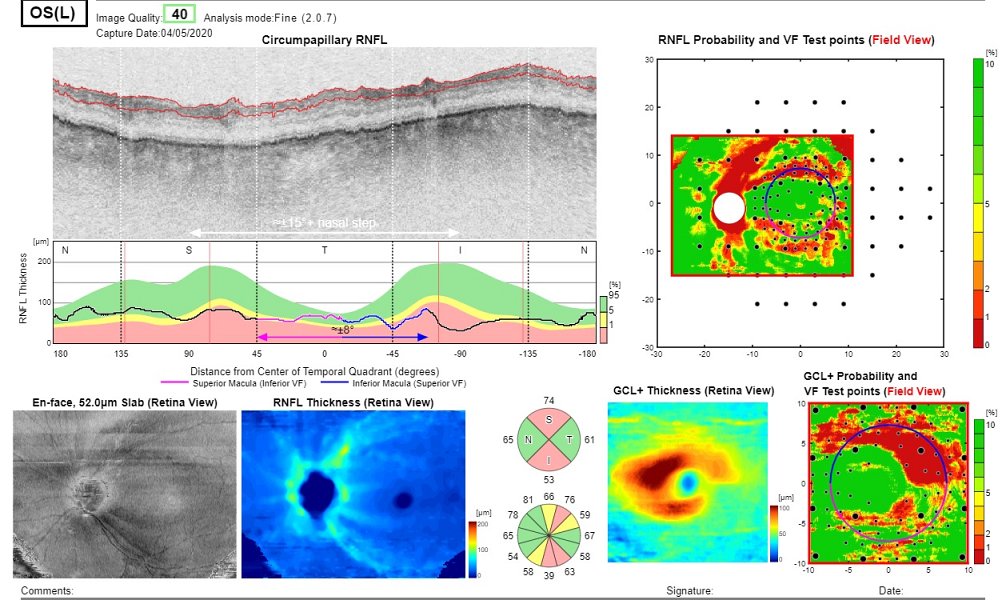 OCT in glaucoma report di Hood
