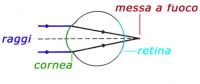 Descrizione: Ipermetropia